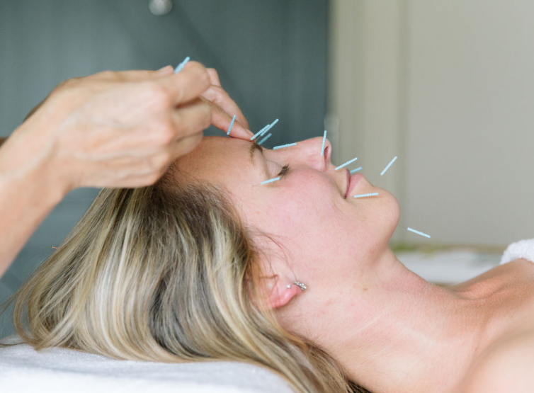It’s more than just Facial Acupuncture